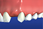 Dental Bridges graphic