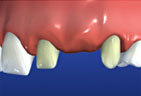 Dental Bridges graphic