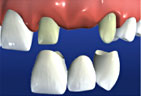 Dental Bridges graphic