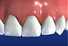 Dental Bridges graphic