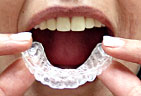 The custom whitening trays fit tightly over your teeth and are worn for the prescribed time image