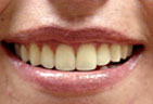 The transparent whitening trays can be worn at night or during the day image