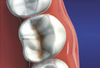 Dental Inlays graphic