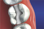 Dental Inlays graphic