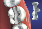 Dental Inlays graphic