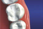 Dental Inlays graphic