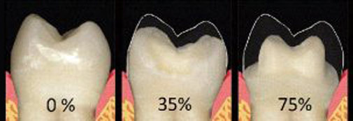 minimal invasive tooth image