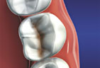 Dental Fillings graphic