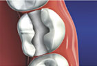 Dental Fillings graphic