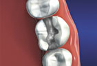 Dental Fillings graphic