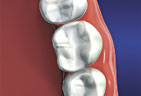 Dental Fillings graphic