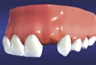 Tooth before Dental Implants graphic