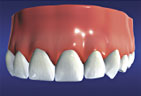 A Crown attached to a Dental Implants graphic