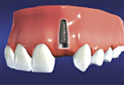 Dental Implants graphic