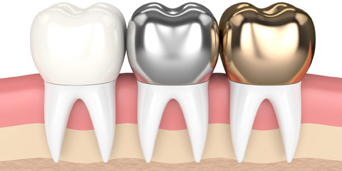 Types of Dental Crowns graphic